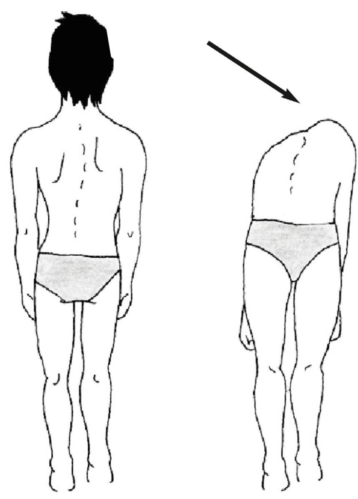 Esame schiena - Test di Adams: valutazione della flessione anteriore del tronco